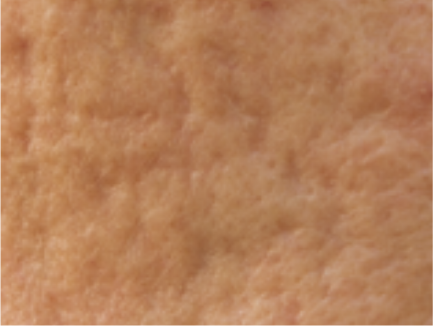 Resurfacing Laser