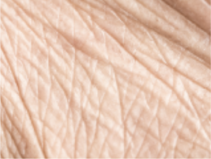 Resurfacing Laser