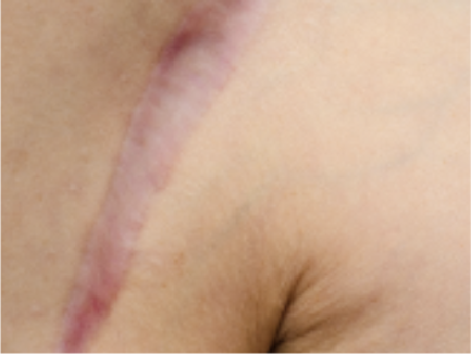 Resurfacing Laser
