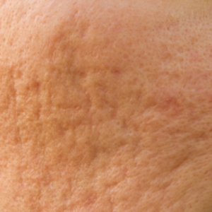 Co2 Laser Skin