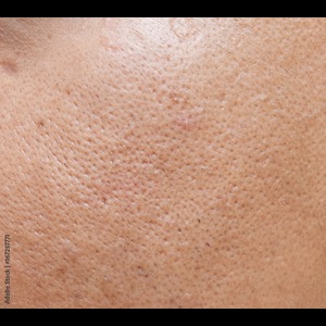 HALO® Laser Treatments