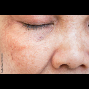 HALO® Laser Treatments