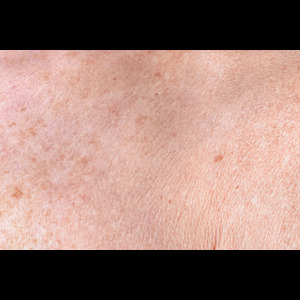 Co2 Laser Skin