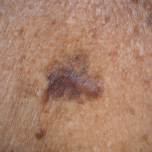 HALO® Laser Treatments