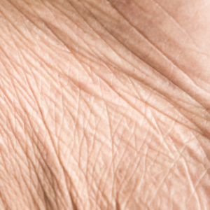 HALO® Laser Treatments