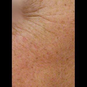 HALO® Laser Treatments