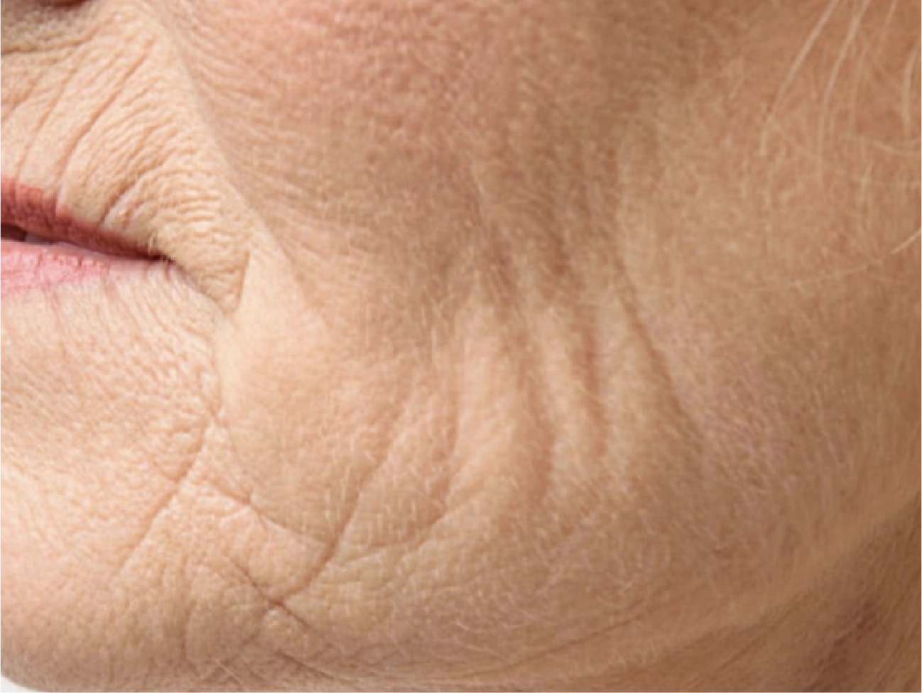 Forever Young Laser Treatment Lebanon