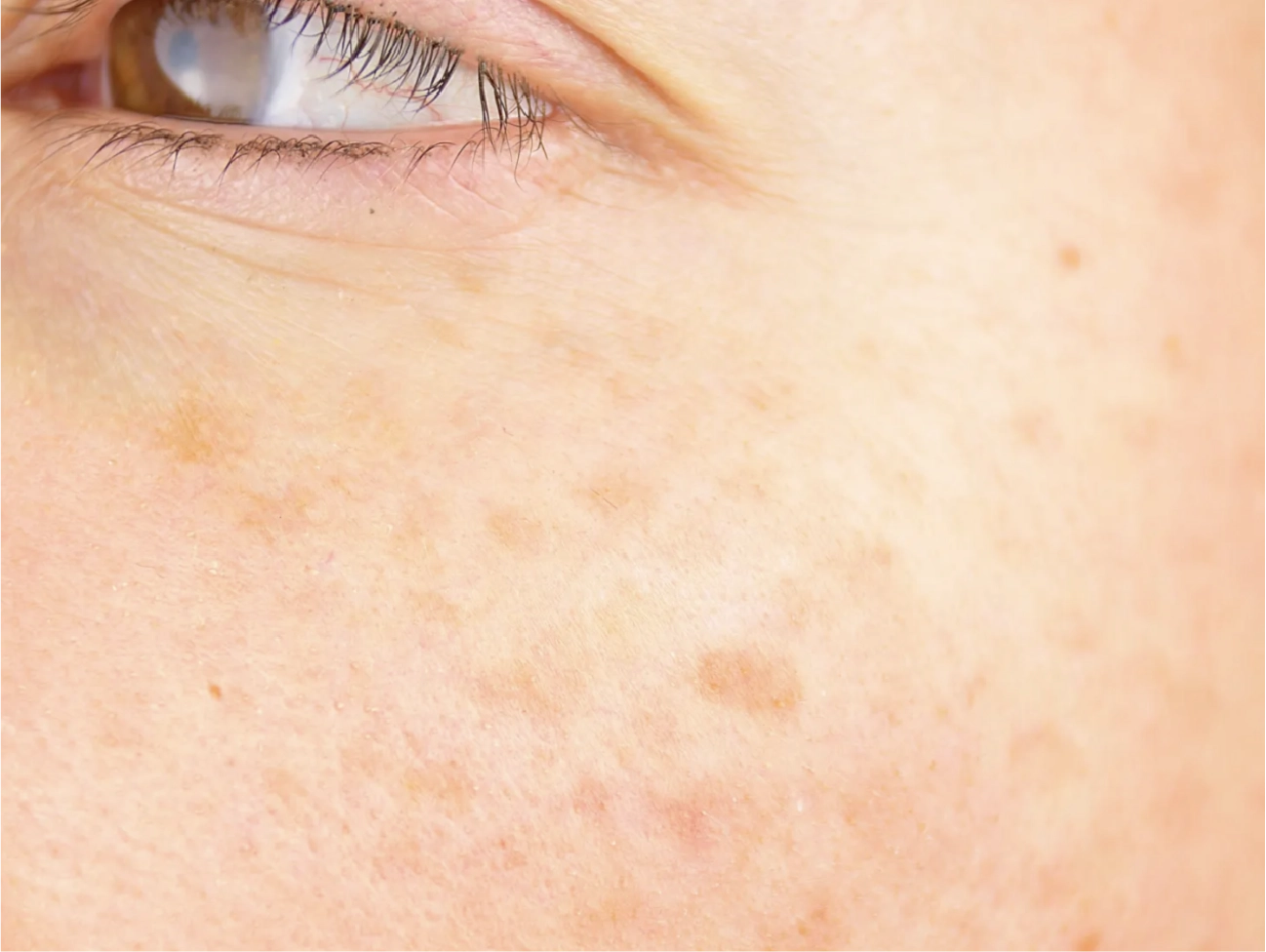 Forever Young Laser Treatment Lebanon