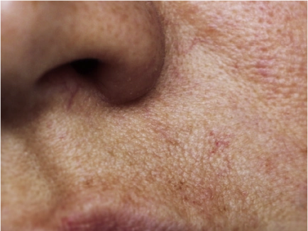 Sciton Laser Treatment