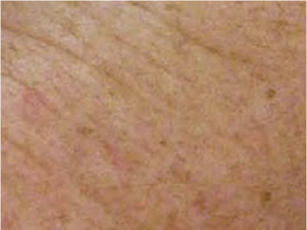 Sciton Laser Treatment
