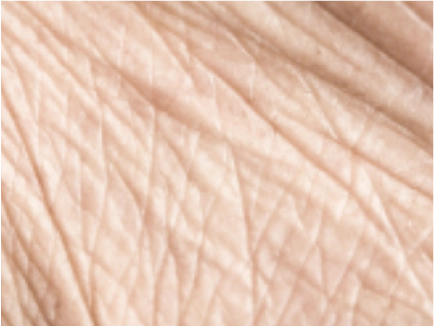 Sciton Laser Treatment