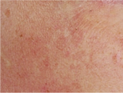 Halo Laser Peel
