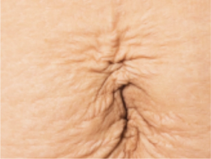 Skin Tightening Treatment