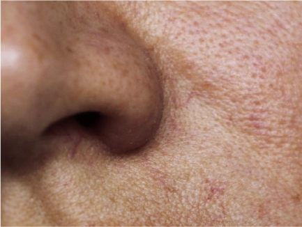Halo Laser Peel